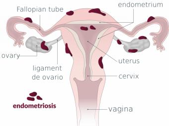 La detección precoz es clave para tratar la endometriosis, una enfermedad crónica que afecta al 10% de las mujeres en edad fértil