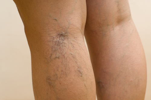 La eliminación de varices ya no requiere de cirugía para su tratamiento