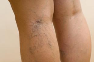 La eliminación de varices ya no requiere de cirugía para su tratamiento
