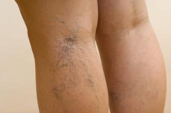 La eliminación de varices ya no requiere de cirugía para su tratamiento