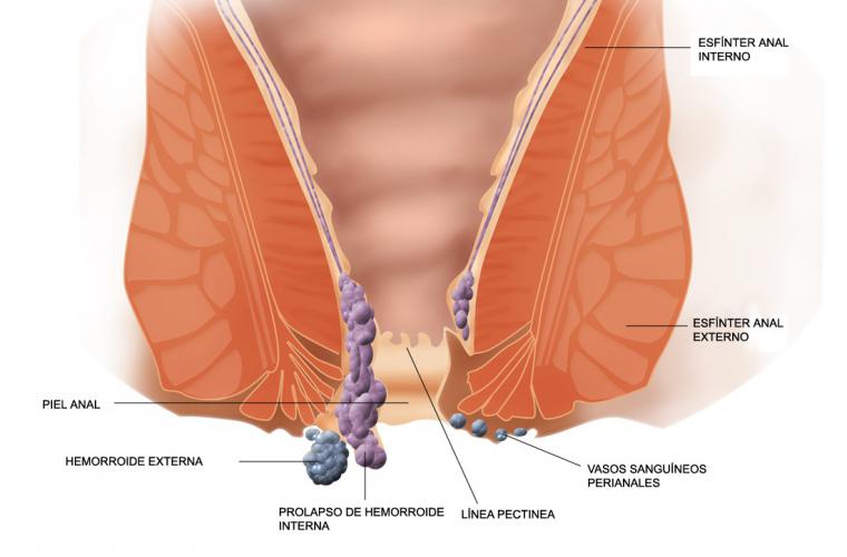 Nuevas técnicas para el tratamiento de las hemorroides, una patología que afectará al 50 % de la población a lo largo de su vida