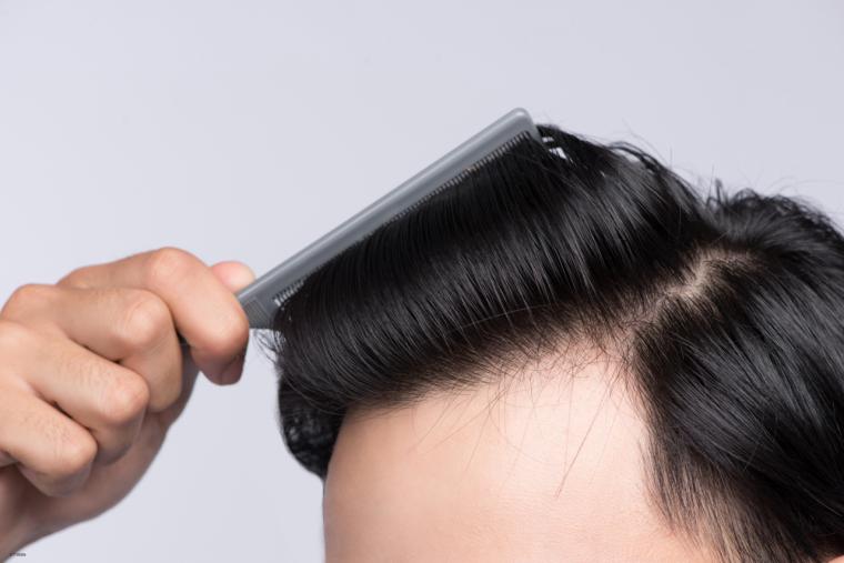 El Dr. Carmona, especialista del Grupo HLA, ha desarrollado una técnica propia para el microinjerto de pelo