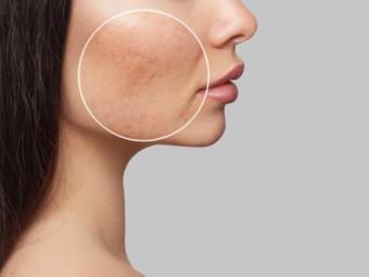 ¿Qué tipos de cicatrices de acné existen y cómo mejorarlas?