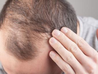 Tecarterapia capilar, la solución para combatir la alopecia