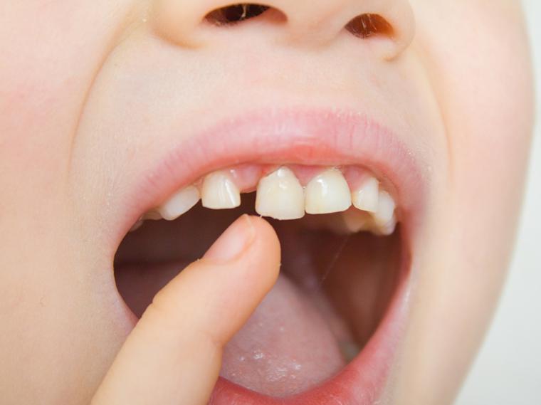 Una buena masticación es fundamental en el desarrollo del niño