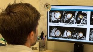 Estudio revela que la hipertrabeculación ventricular no afecta el pronóstico en miocardiopatía dilatada