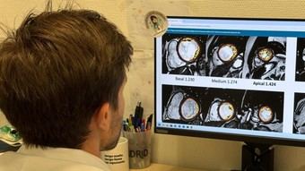 Estudio revela que la hipertrabeculación ventricular no afecta el pronóstico en miocardiopatía dilatada