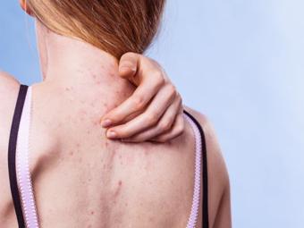 ¿Cómo deshacerse del molesto acné de la espalda?