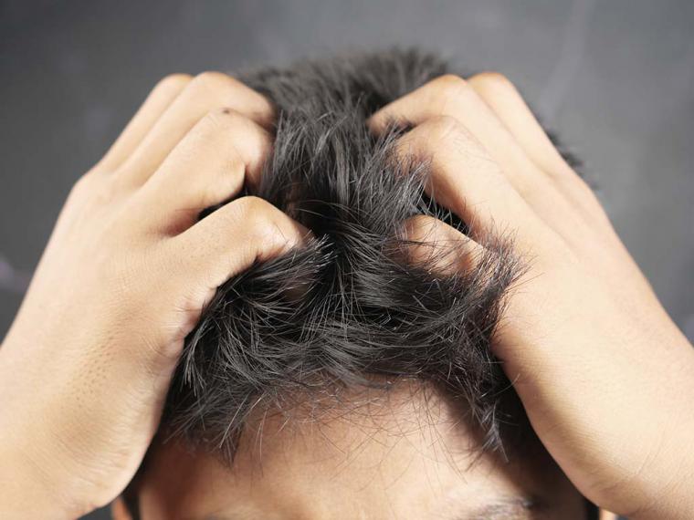 La psoriasis y su relación con la caída del cabello