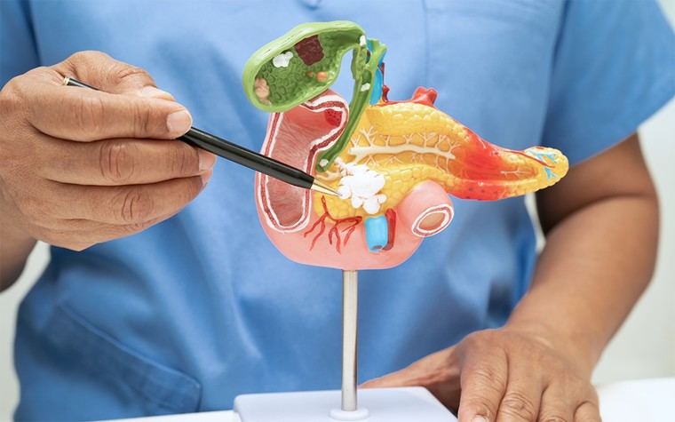 Investigadores logran mejorar la eficacia de la quimioterapia en cáncer de páncreas al adelgazar la membrana tumoral