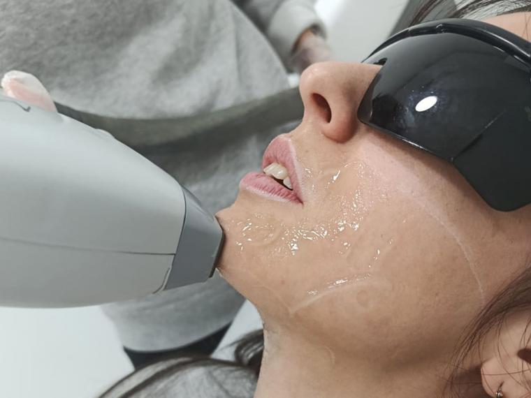 Adiós al tabú: las claves para eliminar el vello facial femenino
