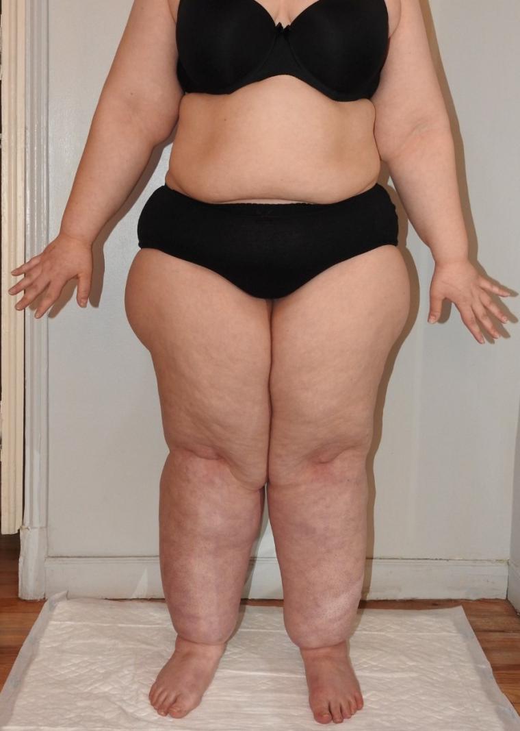 El lipedema, la enfermedad desconocida y dolorosa que afecta casi al 20% de las mujeres