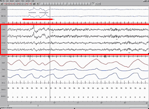 Captura de un registro polisomnográfico representando patrón de ondas cerebrales durante el sueño REM.