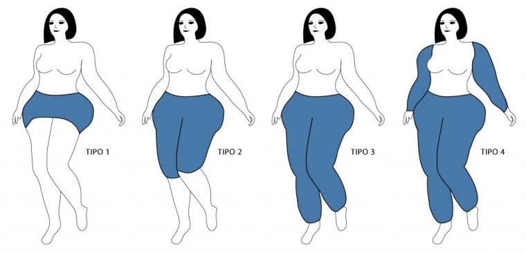 Lipedema: qué es, cómo evoluciona y tipos de tratamientos